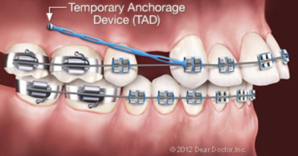 Temporary Anchorage Devices