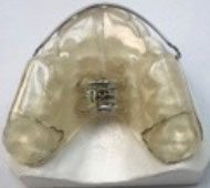 palatal expander model