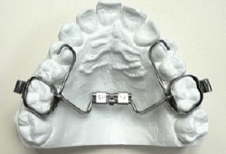 palatal expander model