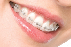 Types of Braces